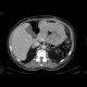 Adrenal tumour, extensive: CT - Computed tomography